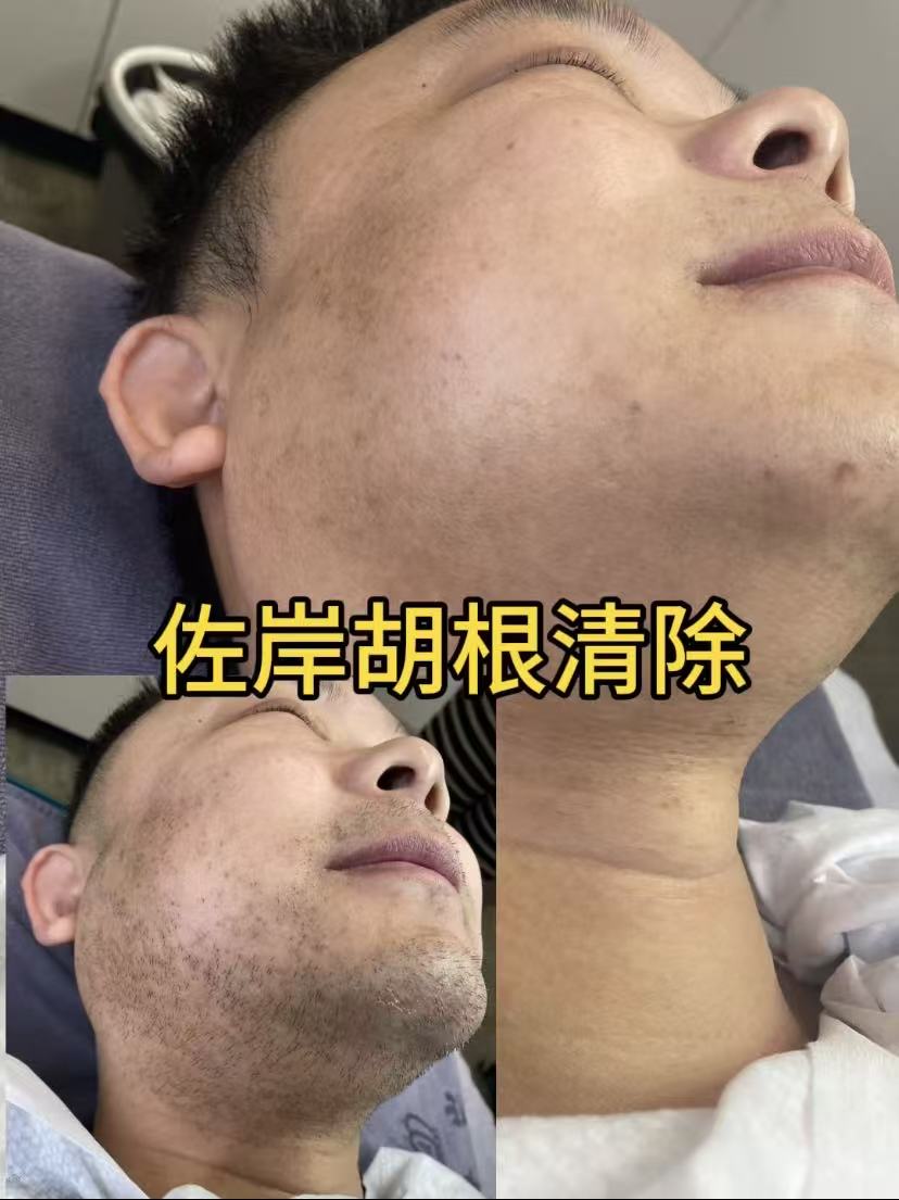 衢州脱毛